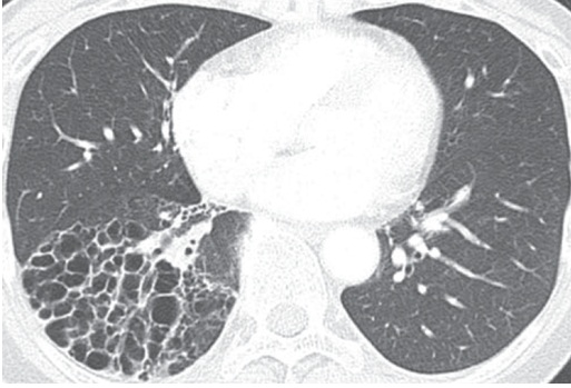 胸部CTにおける蜂巣肺の定義_e0156318_11552190.jpg