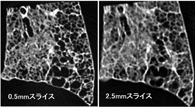 胸部CTにおける蜂巣肺の定義_e0156318_11563016.jpg