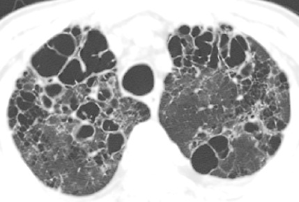 胸部CTにおける蜂巣肺の定義_e0156318_11583499.jpg