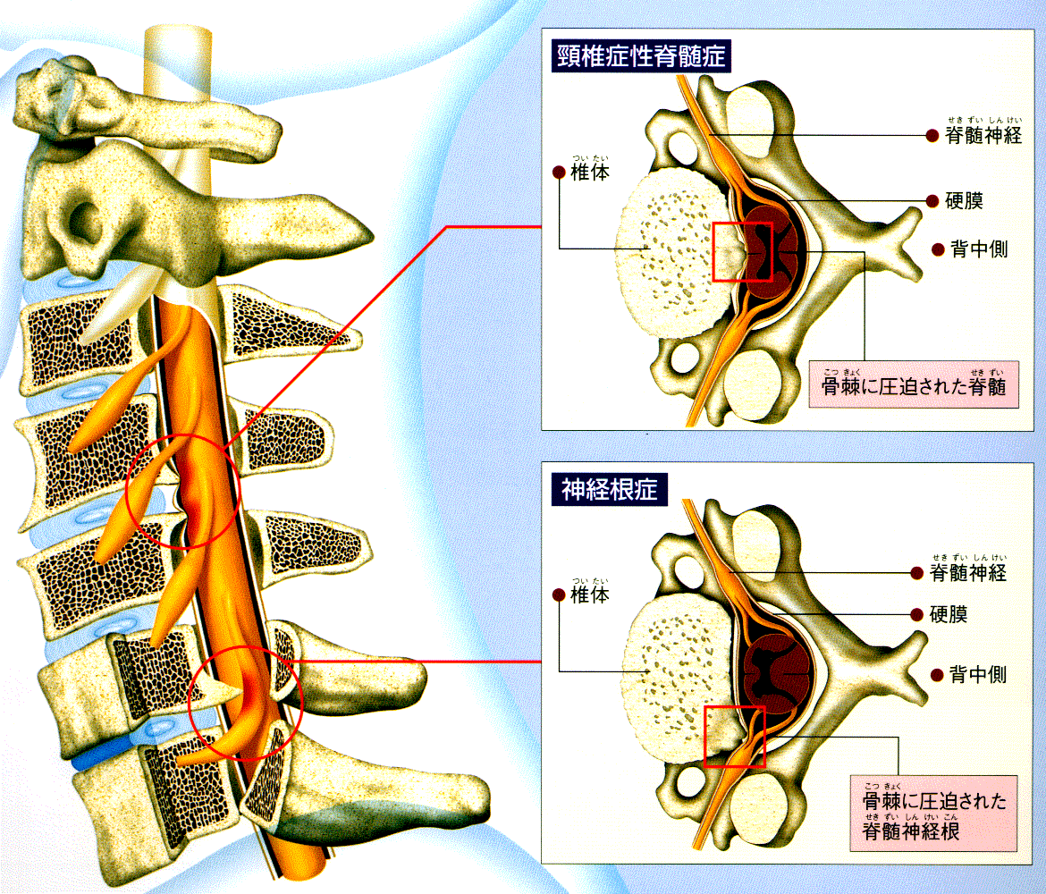 頸椎症神経根症_e0253742_20365673.gif