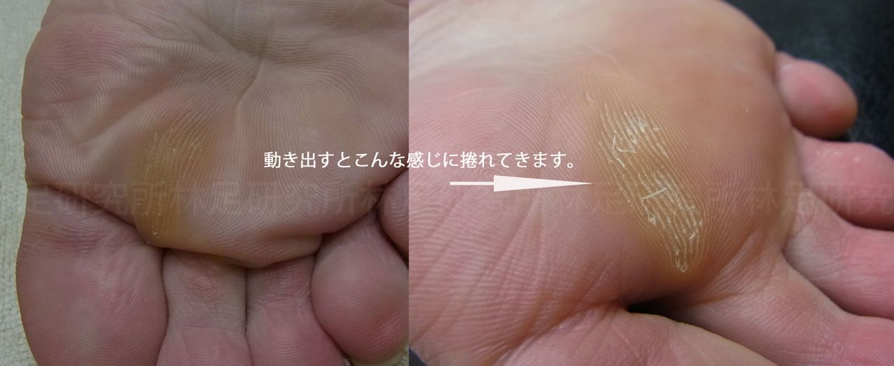 足の裏の角質 タコ 林足研究所 足 外反母趾 修正 日常の日記