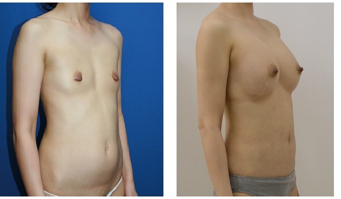 脂肪移植豊胸　２コース終了（計６回施術）　最終施術後約５か月_d0092965_23173157.jpg
