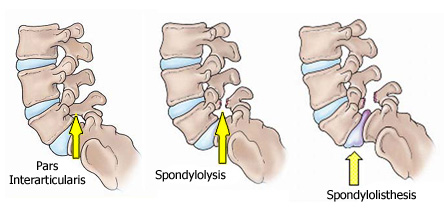 Spondylolisthesis(脊椎すべり症)と向き合う。_b0112009_8132113.jpg