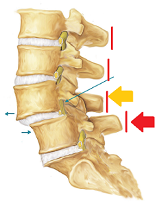 Spondylolisthesis(脊椎すべり症)と向き合う。_b0112009_8521935.png