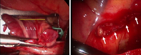 胸腔鏡下左心耳切除術の効果と安全性:JACC誌より_a0119856_19713100.jpg