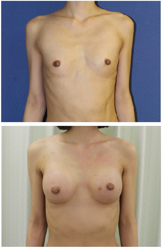 人工乳腺豊胸術　（300cc  cohesive silicone gel implant)_d0092965_21444492.jpg