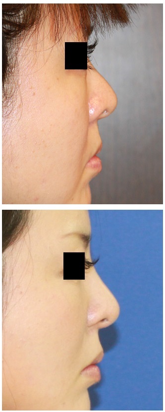 鼻翼基部プロテーゼ（ほうれい線プロテーゼ）による上顎後退の改善　、鼻孔縁拳上術　　術後約2年_d0092965_2103586.jpg