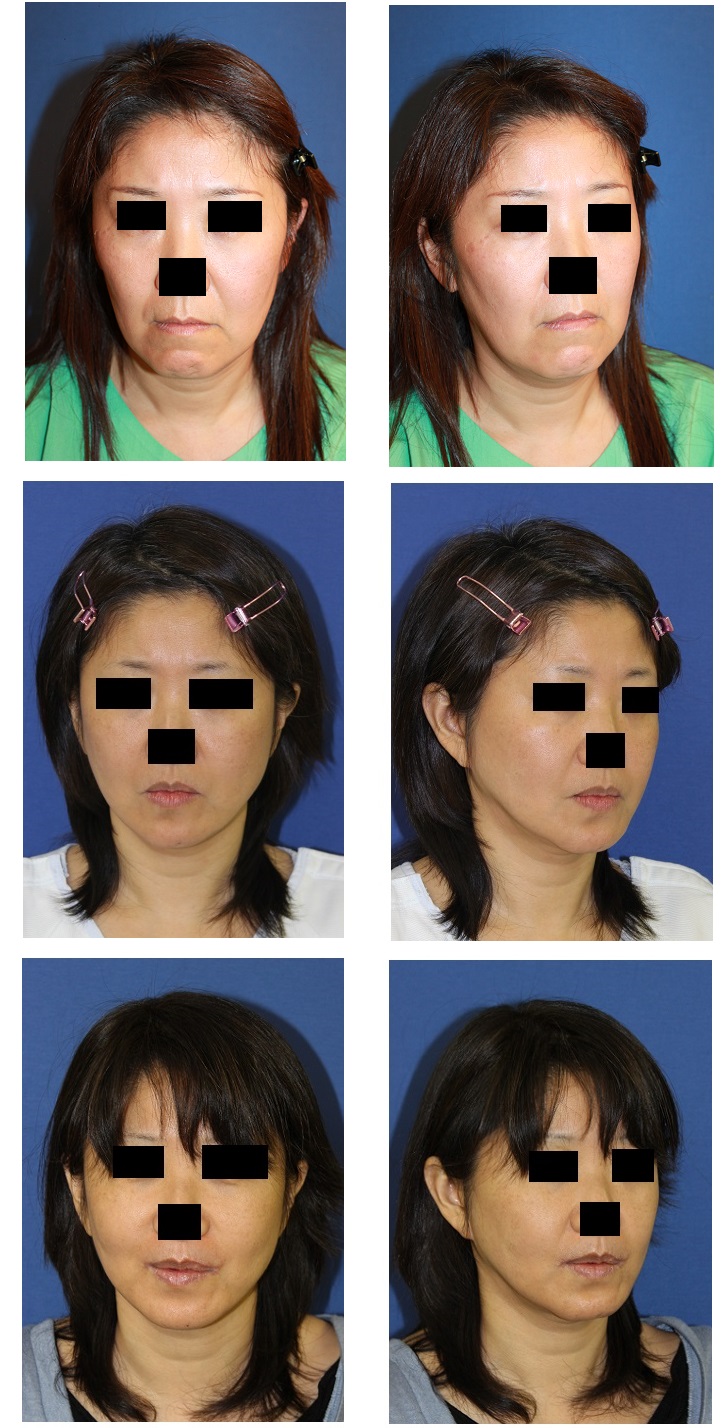 LeFortⅠ型骨切術に対する修正目的にて上顎歯槽骨アパタイト留置、 口角拳上術(外側法)_d0092965_25828100.jpg