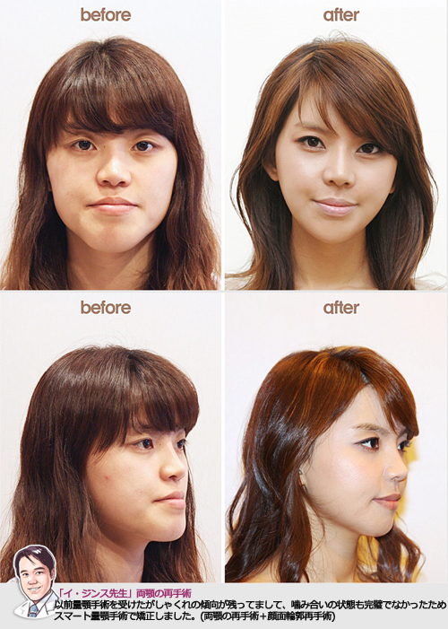 フェイスラインの両顎再手術 韓国美容整形旅行案内会社ナビ 韓国整形ブログ