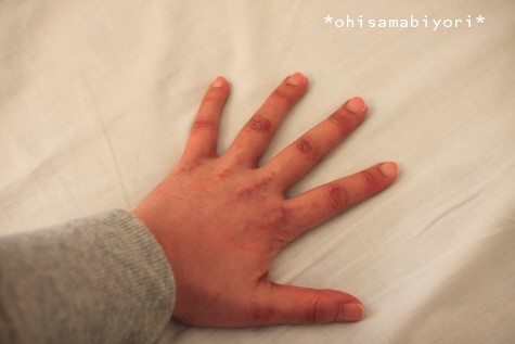 今日の私 入院生活35日目 13年3月27日 おひさま日和 私 皮膚筋炎 多発性筋炎 乳がん 再発 肺転移になりました 今日の私 入院生活35日目 13年3月27日 おひさま日和 私 皮膚筋炎 多発性筋炎 乳がん 再発 肺転移になりました