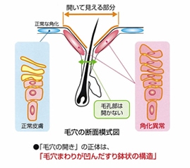 毛穴ケア グリシルグリシン キャンペーン 札幌 美容皮膚科 札幌の美容皮膚科小笠原クリニック澄川診療所 シミ シワ ニキビ アトピー治療 毛穴ケア グリシルグリシン キャンペーン 札幌 美容皮膚科 札幌の美容皮膚科小笠原クリニック澄川診療所 シミ シワ ニキビ アトピー治療