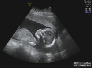 19w2d 妊婦検診 3回目 性別判明 旧 りんごの時間