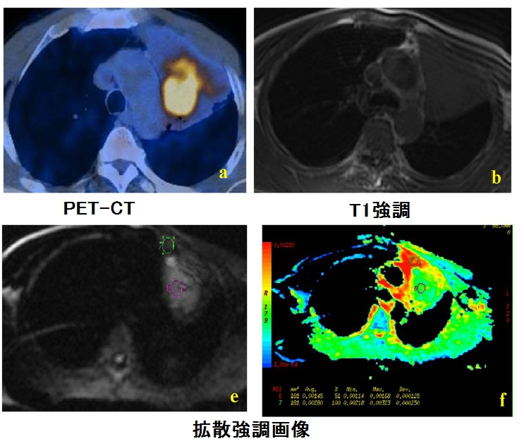 MRIで中枢性肺癌と無気肺の鑑別が可能_e0156318_1513737.jpg