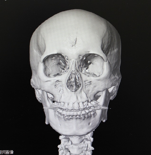 他院形成外科教授頬骨アーチリダクション術後修正術　：　　　頬骨再構築　　、　　ミラクルリフト_d0092965_3413943.jpg