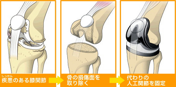 人工膝関節置換術_a0053063_1042295.jpg