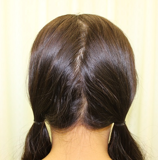 ロアーリフト後のもみあげ消失に対する植毛術,　左ほうれい線剥離術およびヒアルロン酸注入術_d0092965_232514100.jpg