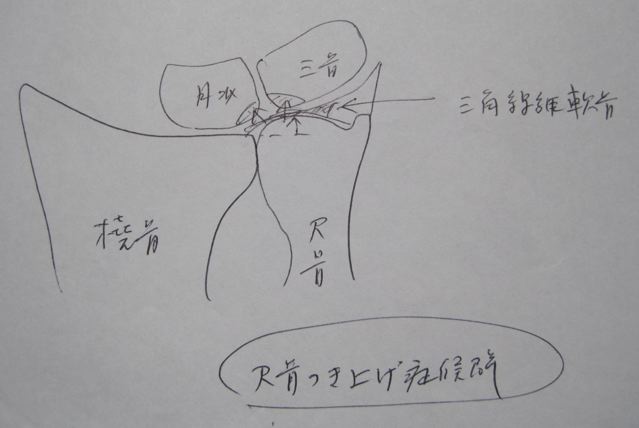 尺骨突き上げ症候群 ひだまり えんがわ 尺骨突き上げ症候群 ひだまり えんがわ