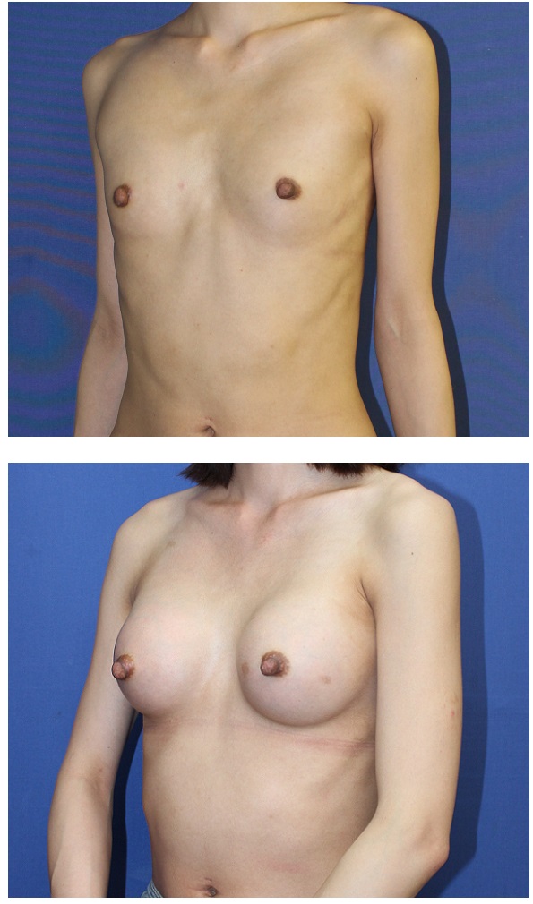 人工乳腺豊胸術 (300cc cohesive silicone gel implant)_d0092965_0174063.jpg