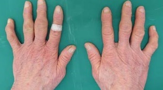 85歳でリュウマチNO,２・・・指が赤く腫れて_e0097212_22465463.jpg