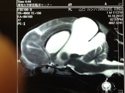 ルンバ手術から1年が過ぎました_a0126743_05367.jpg