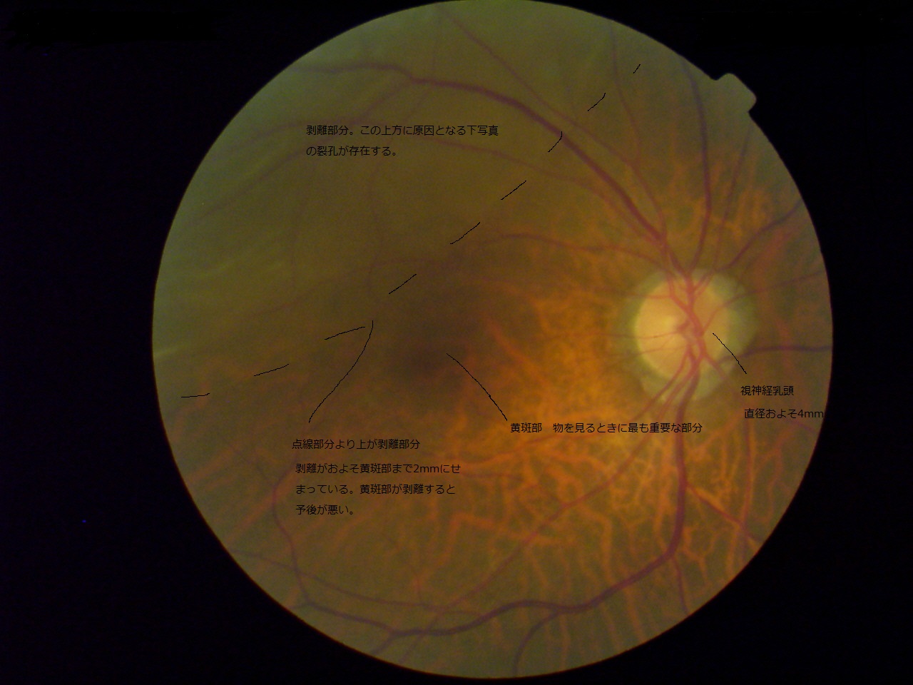 飛蚊症と網膜剥離_d0232846_12472613.jpg