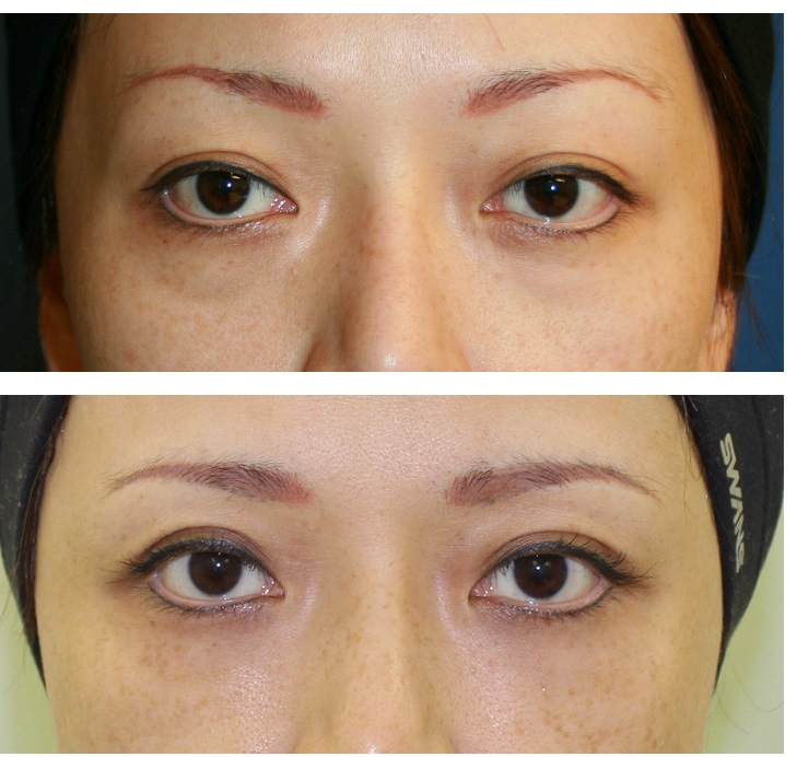 眉下切開法：　上眼瞼リフト（上眼瞼のたるみ改善）　　　　脂肪移植ＦＡＭI法：　下眼瞼のたるみ改善_d0092965_1311632.jpg