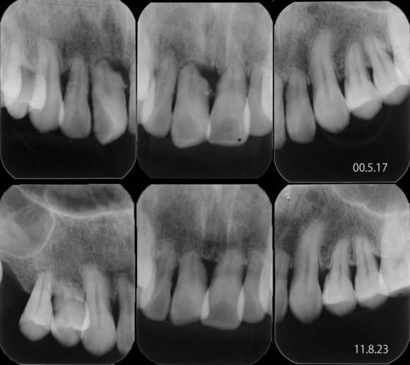 重度歯周病と部位特異性_f0154626_16225037.jpg