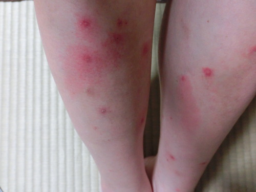 虫刺されに注意 田舎暮らしのケセラセラ1 虫刺されに注意 田舎暮らしのケセラセラ1