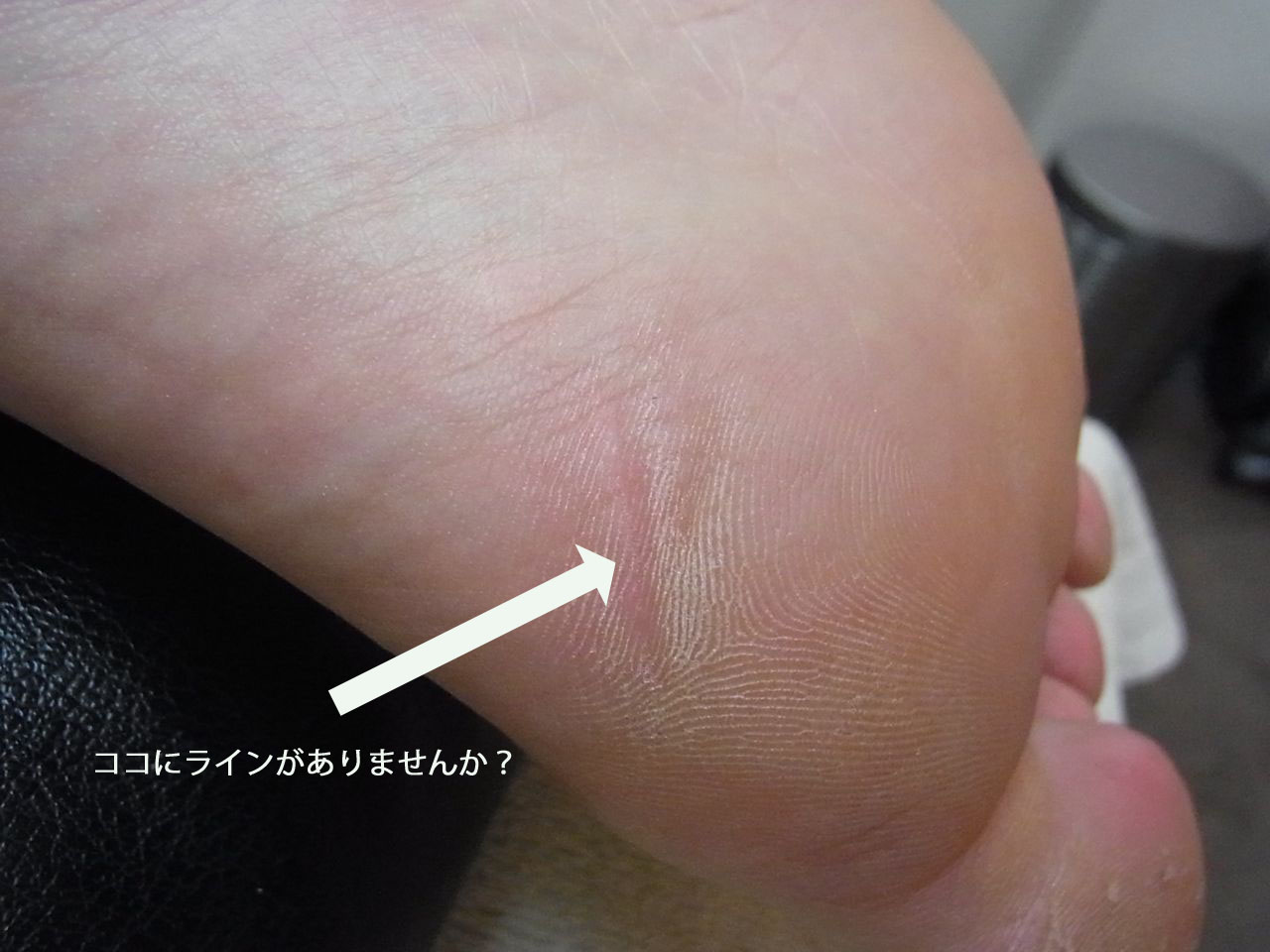 甲高な足裏にある共通点 甲が高い足 林足研究所 足 外反母趾 修正 日常の日記 甲高な足裏にある共通点 甲が高い足 林足研究所 足 外反母趾 修正 日常の日記