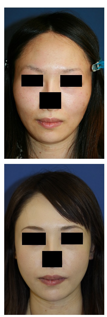 頬骨再構築法、口角拡大術　術後約２年５か月_d0092965_412416.jpg