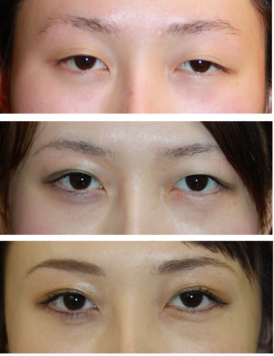 左目眼瞼下垂修正　　　および　術後修正_d0092965_4474828.jpg