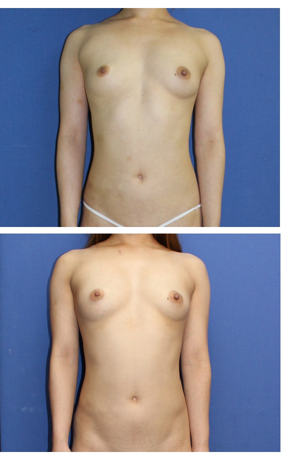 右胸脂肪移植豊胸　術後1か月_d0092965_159011.jpg