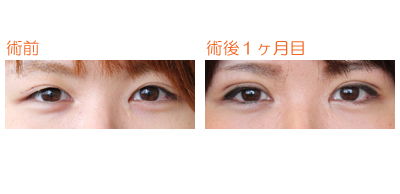 二重 埋没法 術後1ヶ月目 dr勝間田のブログ 二重 埋没法 術後1ヶ月目 dr勝間田のブログ