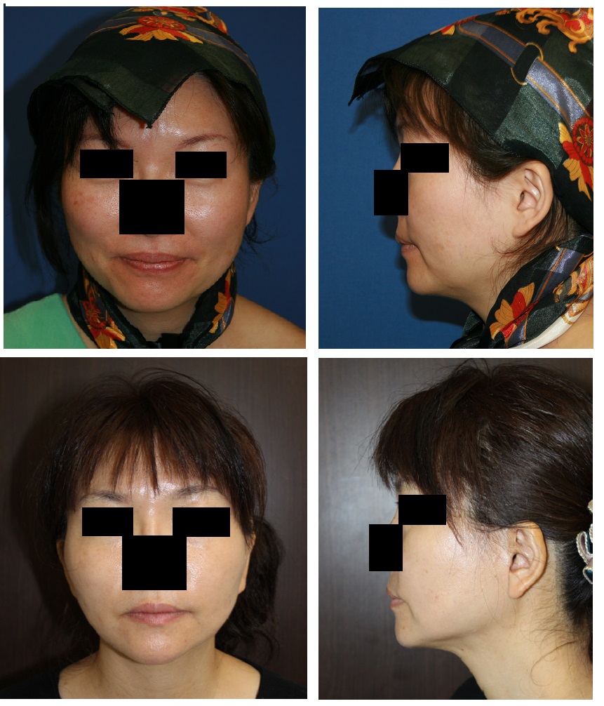 顎下脂肪吸引、ロアーリフト、ケーブルリフト　術後約6年_d0092965_22385770.jpg