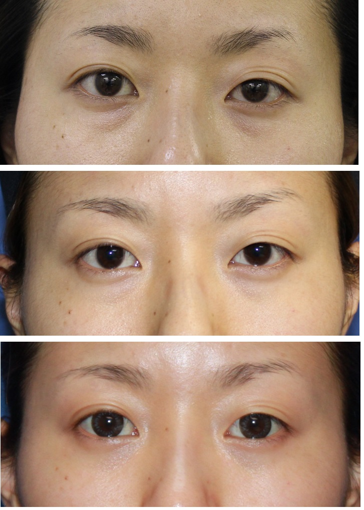 目の下の脂肪とり　　　（アキュスカルプレーザー　および　外科手術療法）_d0092965_3102151.jpg