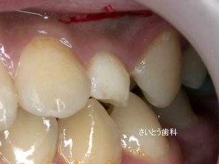 歯牙腫_b0196070_14153358.jpg