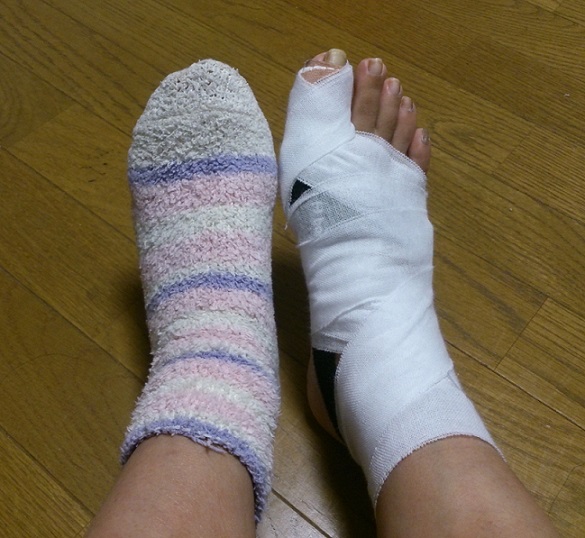 初めての 骨折 笑 新 Lanilaniな日々 初めての 骨折 笑 新 Lanilaniな日々