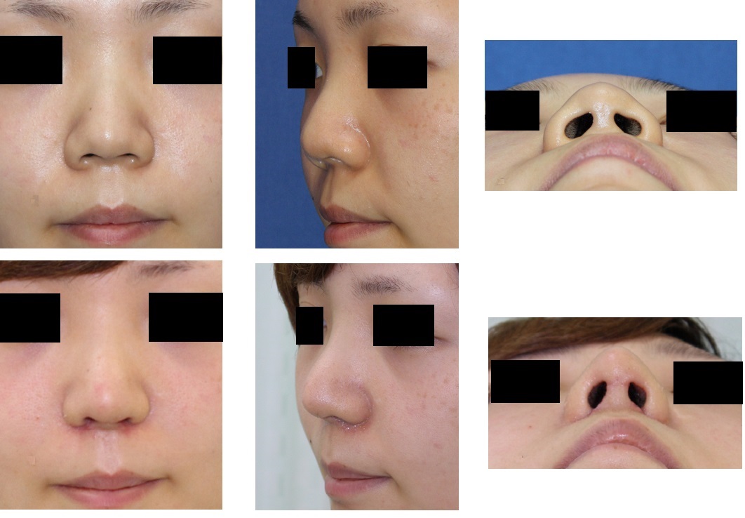 鼻中隔延長術、小鼻縮小術、鼻尖縮小術（オープン法）、鼻口唇角形成術_d0092965_3135296.jpg