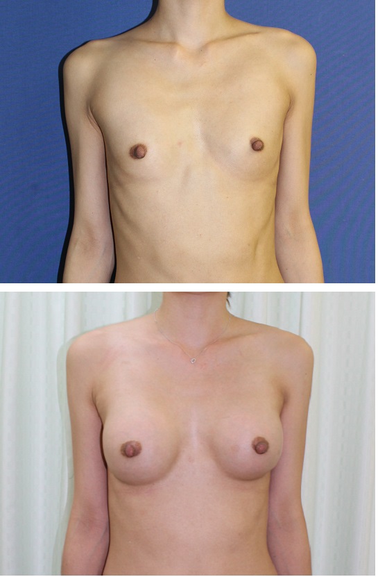 人工乳腺豊胸術 (300cc cohesive silicone gel implant) 術後8か月_d0092965_18186.jpg