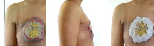 皮膚転移 13年12月画像 猫飯診療所 乳がん再発の記録