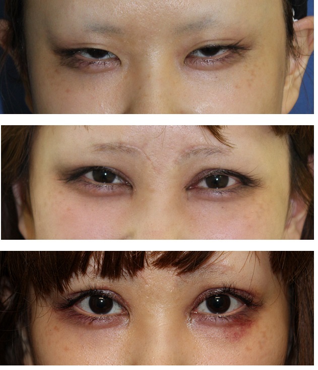 たれ眉形成術、眼瞼下垂修正術、目がしら切開術 後の 左目頭切開術後修正、左右二重切開修正_d0092965_216199.jpg