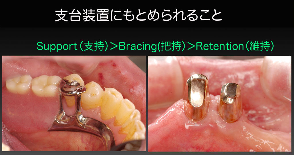 やっぱりノンクラスプ義歯はきらいだ〜その2〜_d0148776_1423431.jpg