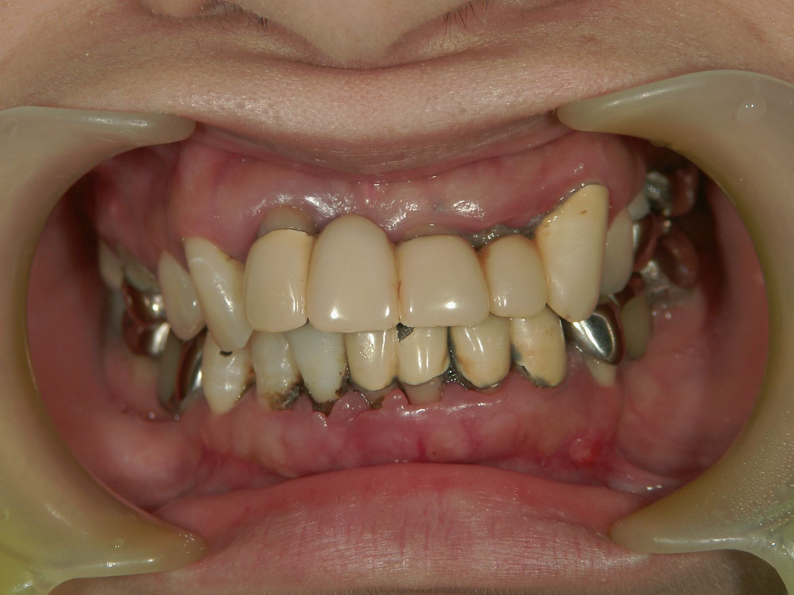 重度の歯周病を歯周外科にて治療してセラミック修復を行った症例_b0119466_23513712.jpg