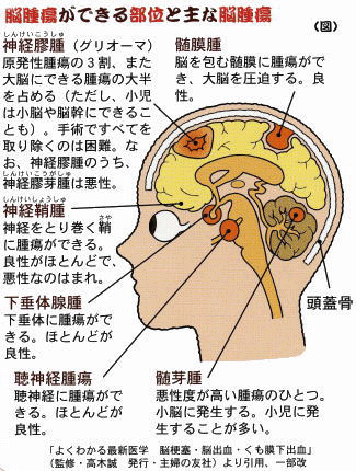 脳腫瘍の予備知識_a0044453_1923740.gif