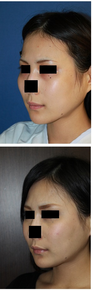 頬骨前方削り術後約2年5ヶ月_d0092965_6223216.jpg