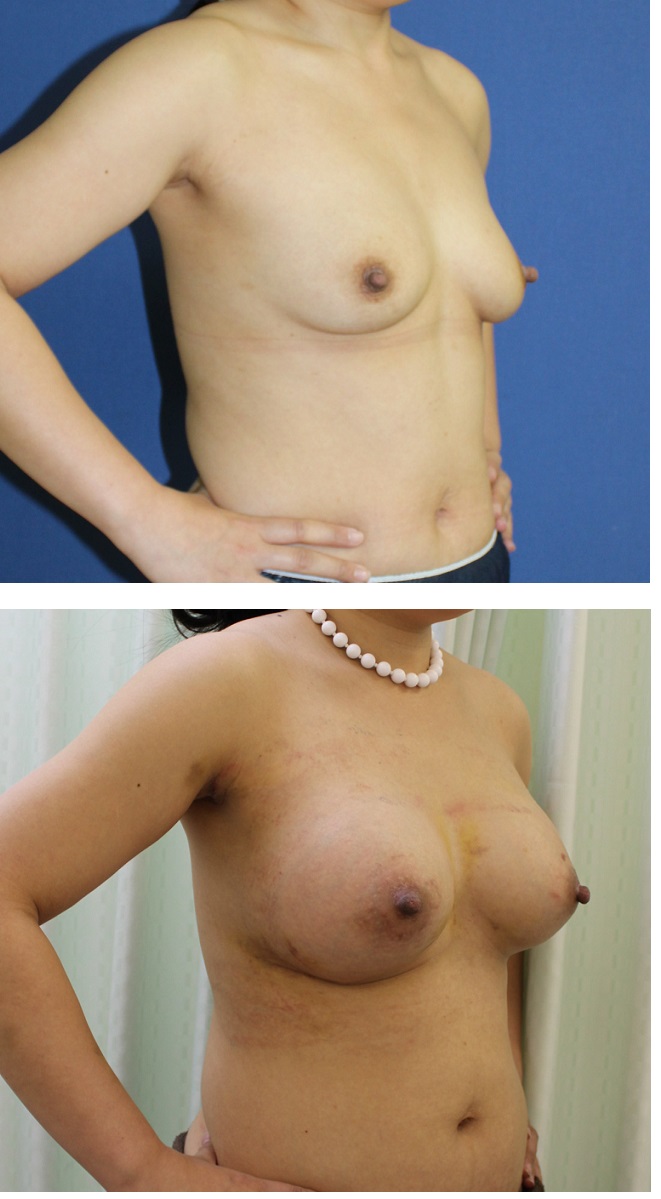 人工乳腺による乳房増大術(シリコンバック豊胸術)_d0092965_4161753.jpg