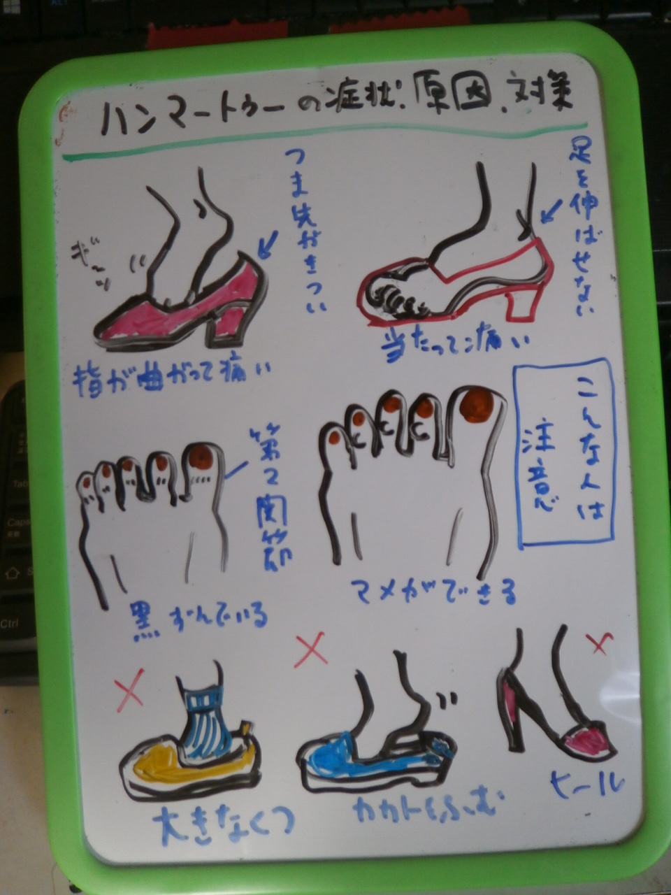 ハンマートゥーの症状 原因 手当て 予防法 動画付き 整体 ツボゲッチューりらく屋 朝霞 ハンマートゥーの症状 原因 手当て 予防法 動画付き 整体 ツボゲッチューりらく屋 朝霞