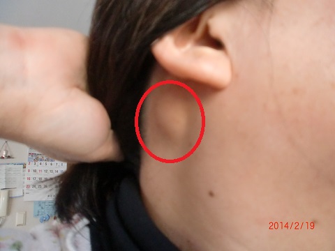 痛い 押す と 耳 しこり 耳下腺腫瘍