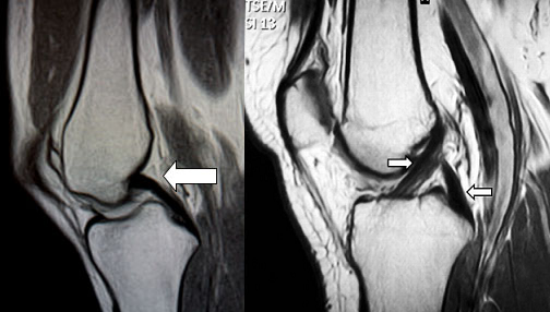 後十字靱帯(PCL)断裂の診断について考察する。_b0112009_9351031.png