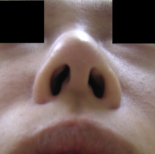 レーザー鼻尖縮小術　、鼻腔内キズ修正　術後約5日_d0092965_242468.jpg